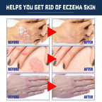Spray Calmant Psoriasis – Soulagement & Hydratation Instantanés