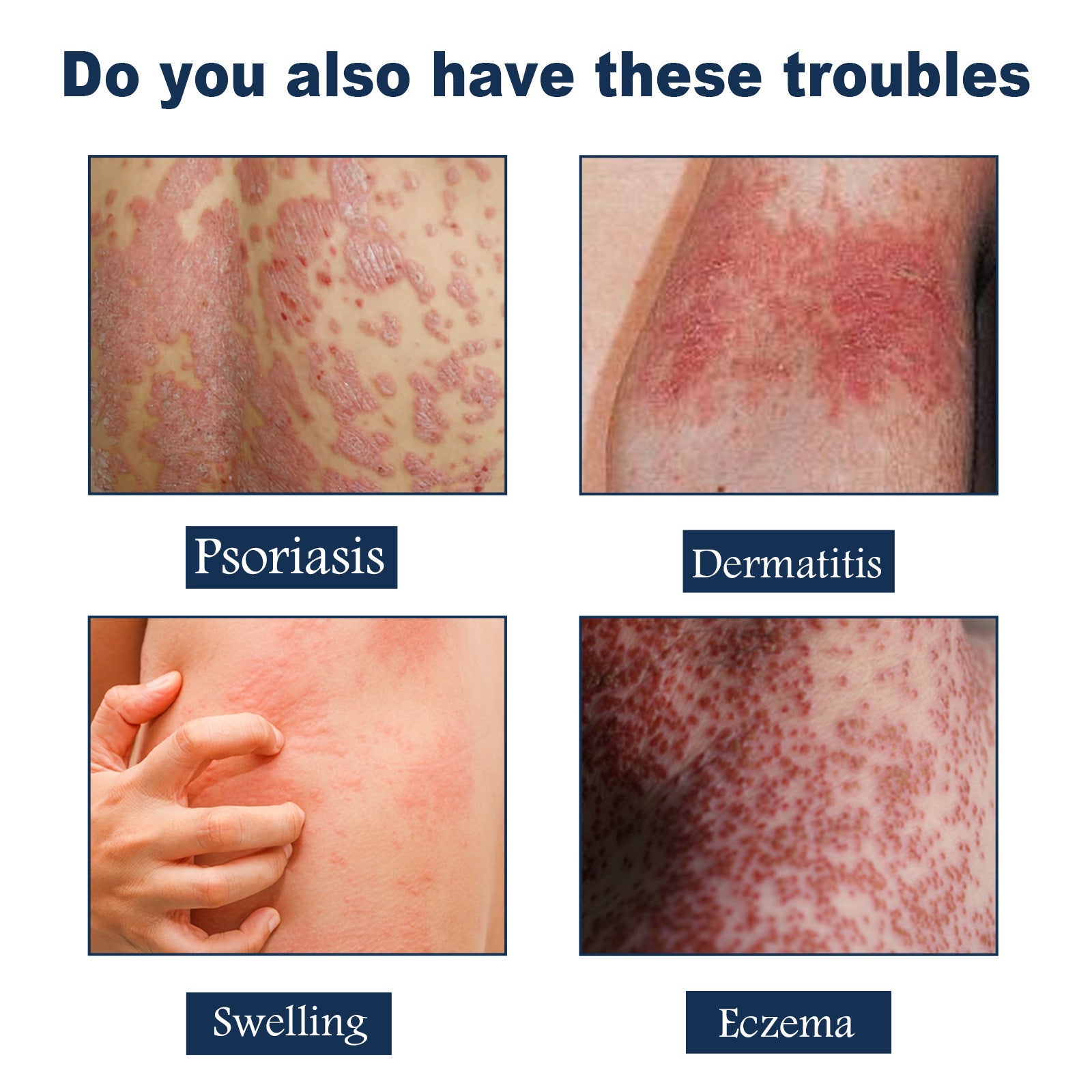 Spray Calmant Psoriasis – Soulagement & Hydratation Instantanés